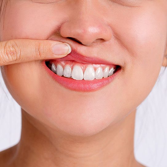 How Can I Defend Against Gum Recession? Endodontic Associates